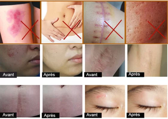 Crème anti-cicatrices jeunesse 