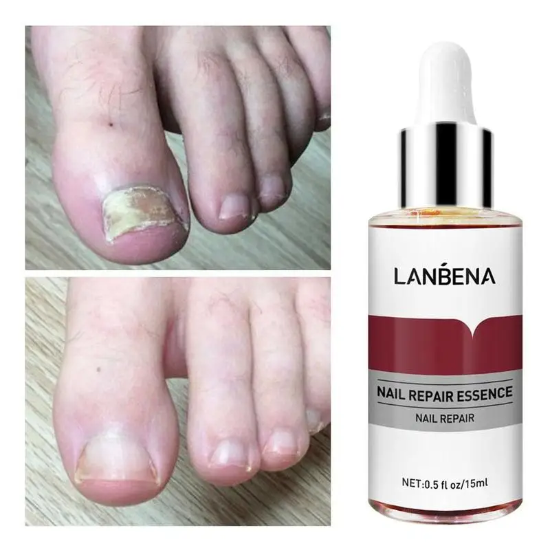 LANBENA-Sérum réparateur pour les ongles