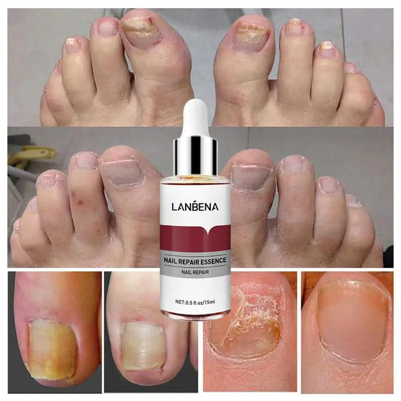 LANBENA-Sérum réparateur adapté aux ongles