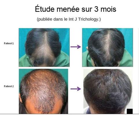 Avant et après utilisation du rouleau repousse cheveux & barbe par les hommes
