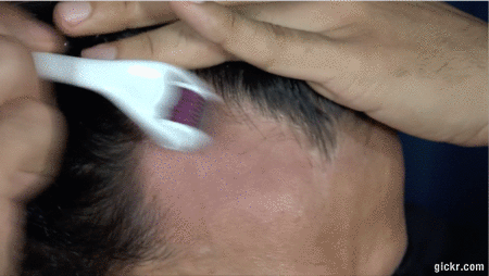 roller repousse cheveux microneedling accélérateur de croissance du cheveu